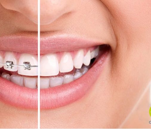 ¿Por qué hacer un tratamiento de ortodoncia en Clínica Dental Oré?