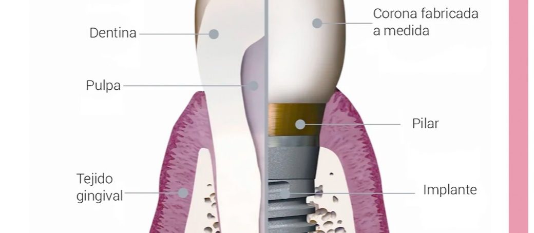 ¿De qué partes se compone un implante?