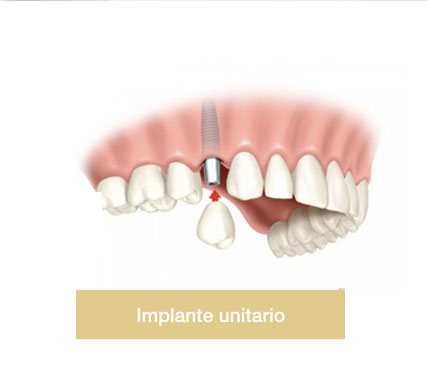 Implante Unitario