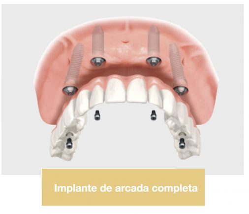 Implantes De Arcada Completa