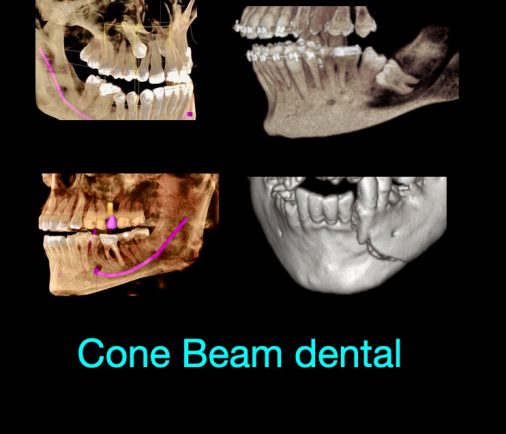 ¿Qué es un estudio de Cone Beam dental?