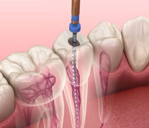 ¿Qué son las endodoncias dentales?