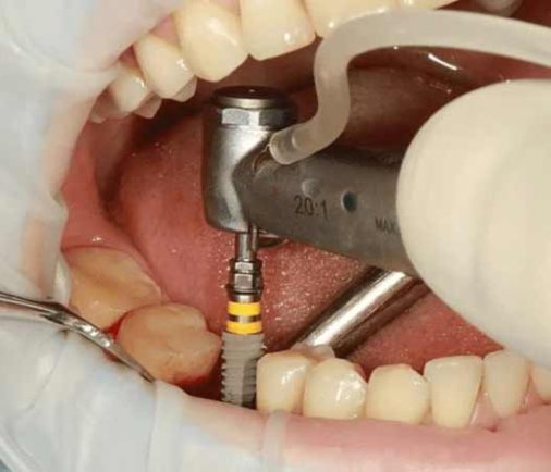 Recupera tu sonrisa con los Implantes Dentales