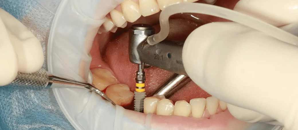Recupera tu sonrisa con los Implantes Dentales