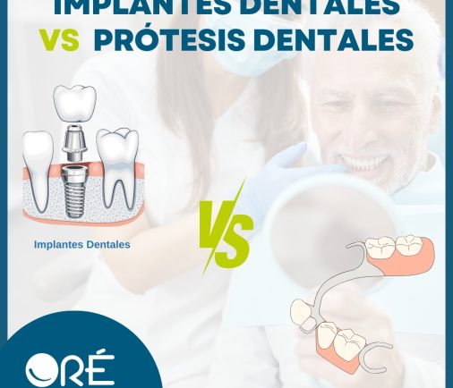 Implantes Dentales vs Prótesis Dentales