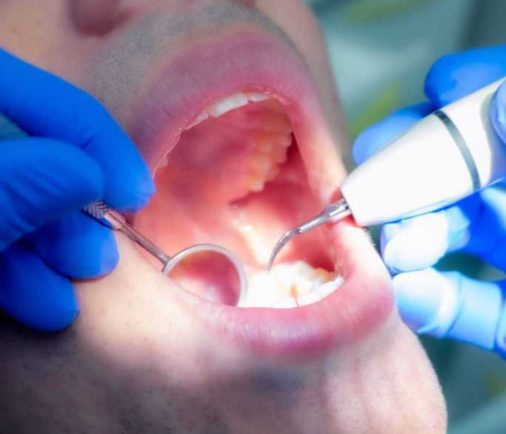 ¿Qué es la Profilaxis Dental?