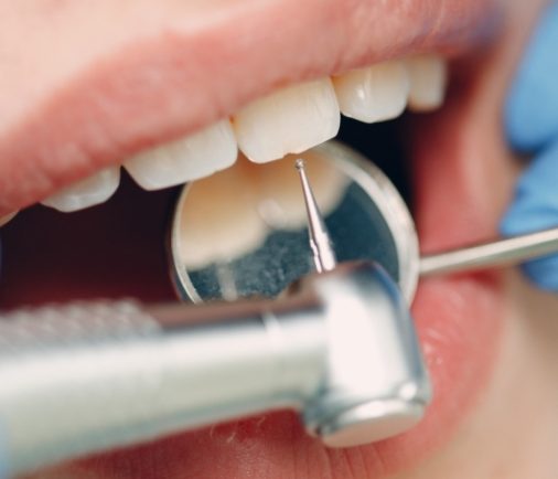 ¿Qué es la profilaxis dental y cada cuanto hacerse una?
