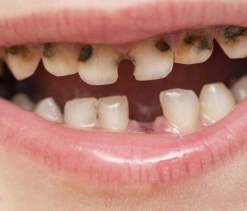 Caries en dientes de leche: el problema que muchos padres subestiman
