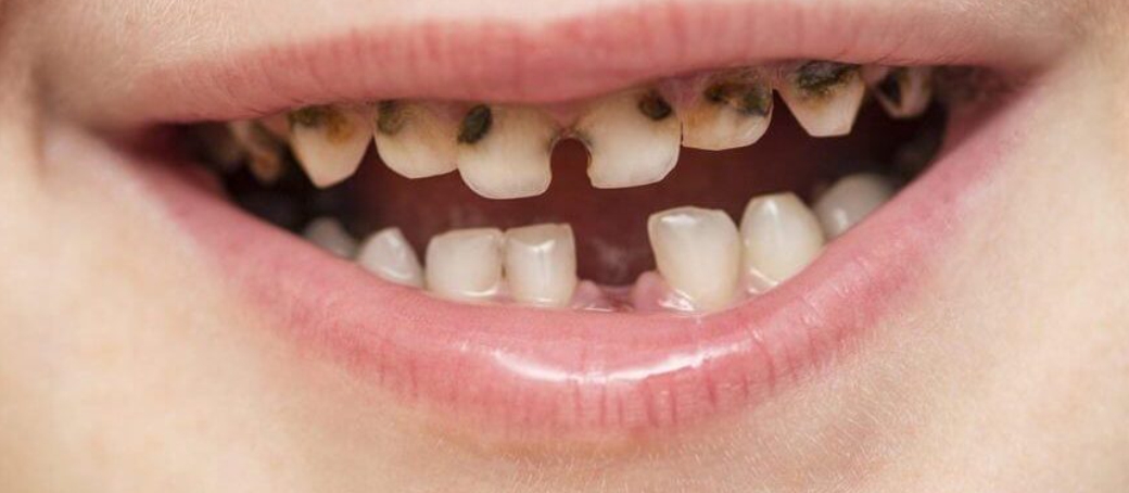 Caries en dientes de leche: el problema que muchos padres subestiman