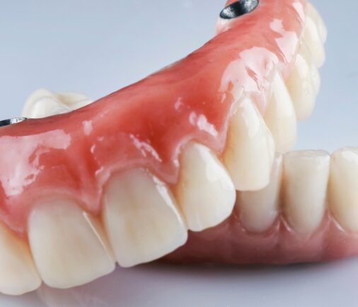 ¿Qué es una prótesis sobre implantes y por qué es la mejor opción para recuperar tu sonrisa?