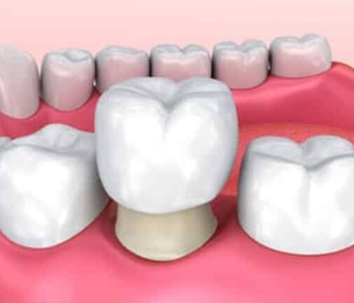 ¿Qué es una corona dental y cuándo se recomienda colocarla?