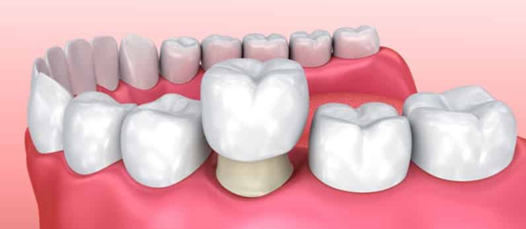 ¿Qué es una corona dental y cuándo se recomienda colocarla?