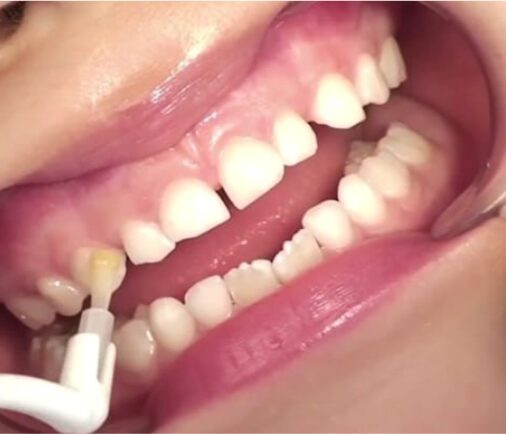 Flúor barniz: protección avanzada para tus dientes