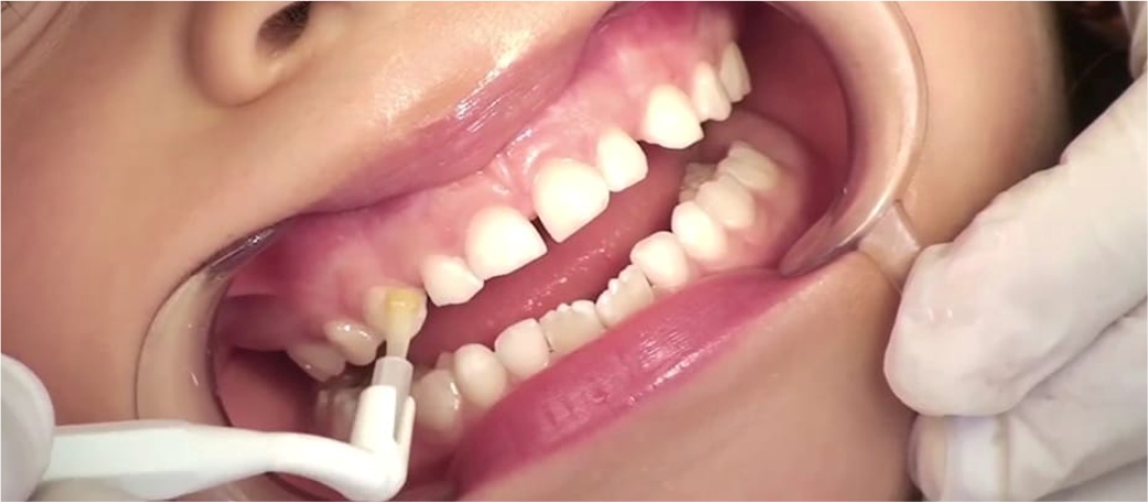 Flúor barniz: protección avanzada para tus dientes