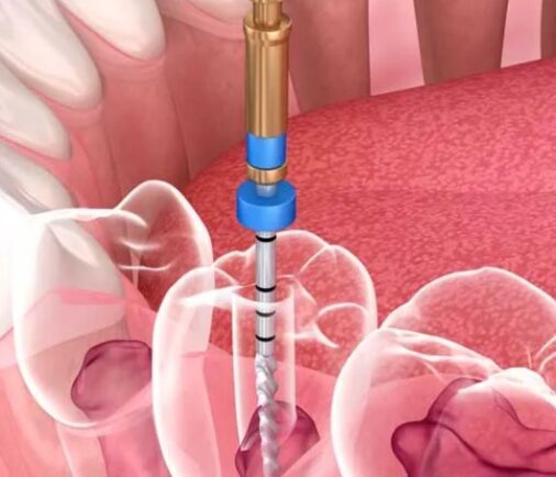 Ventajas de realizarse una endodoncia con sistema rotatorio