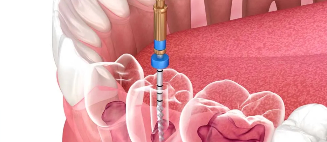 Ventajas de realizarse una endodoncia con sistema rotatorio