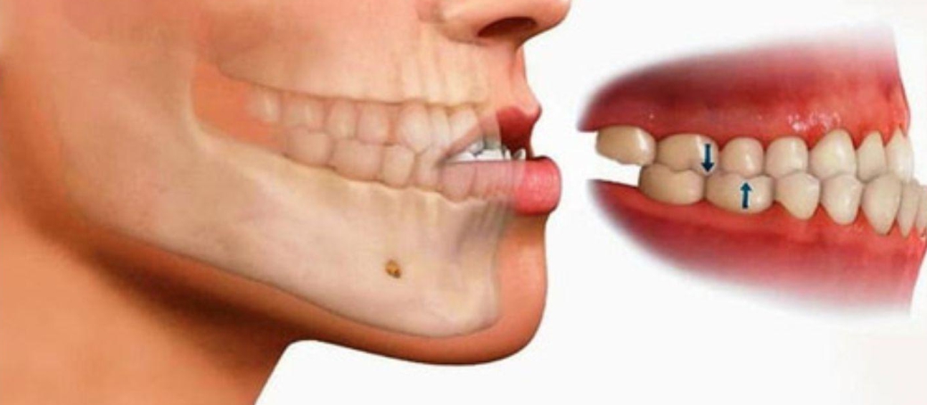 ¿Qué es una maloclusión dental y cómo puede afectarte?