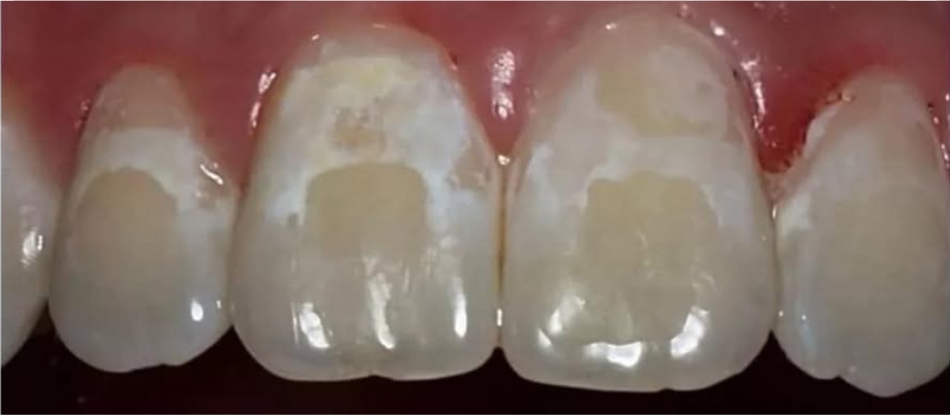 ¿Qué es la desmineralización dental y por qué aparece?